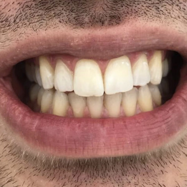 Alveolit Diş Çekimi Sonrası Ağrı GC Clinic Diş Polikliniği