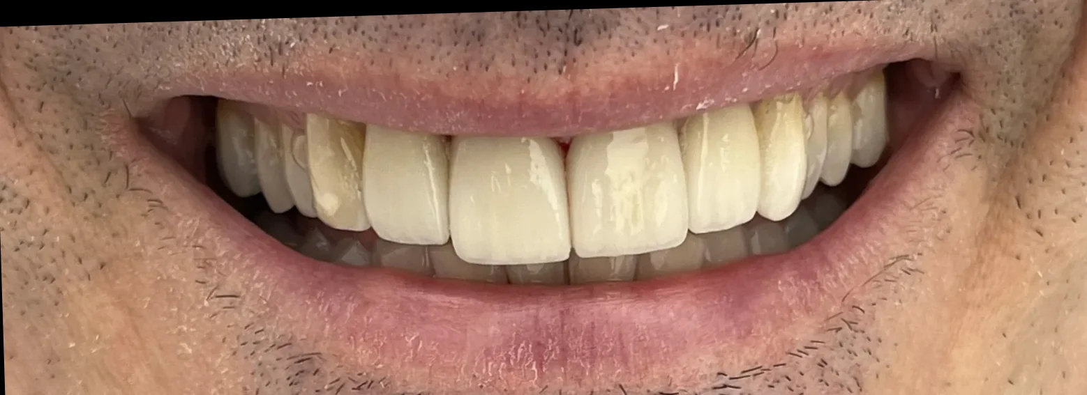 Minimal İnvaziv Gülüş İyileştirmesi sonrası