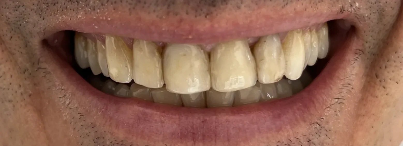 Minimal İnvaziv Gülüş İyileştirmesi öncesi