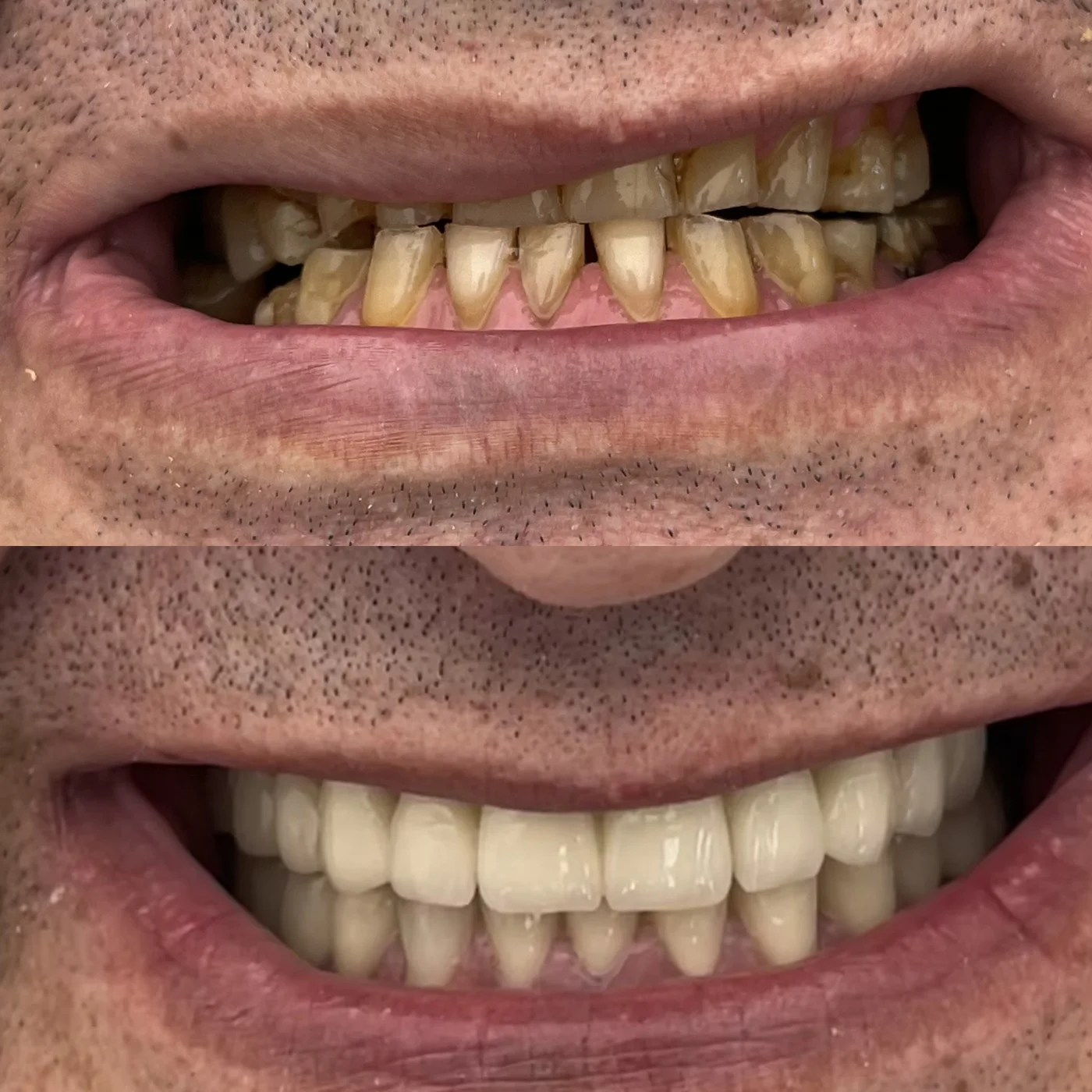 Diş sıkmaya bağlı ileri aşınma öncesi ve sonrası — Ivoclar e.max seramik kronlar ve Straumann implantlarla kapanış yeniden kuruldu, GC Clinic Nişantaşı gerçek vaka